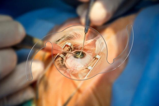 Premium IOL Surgery